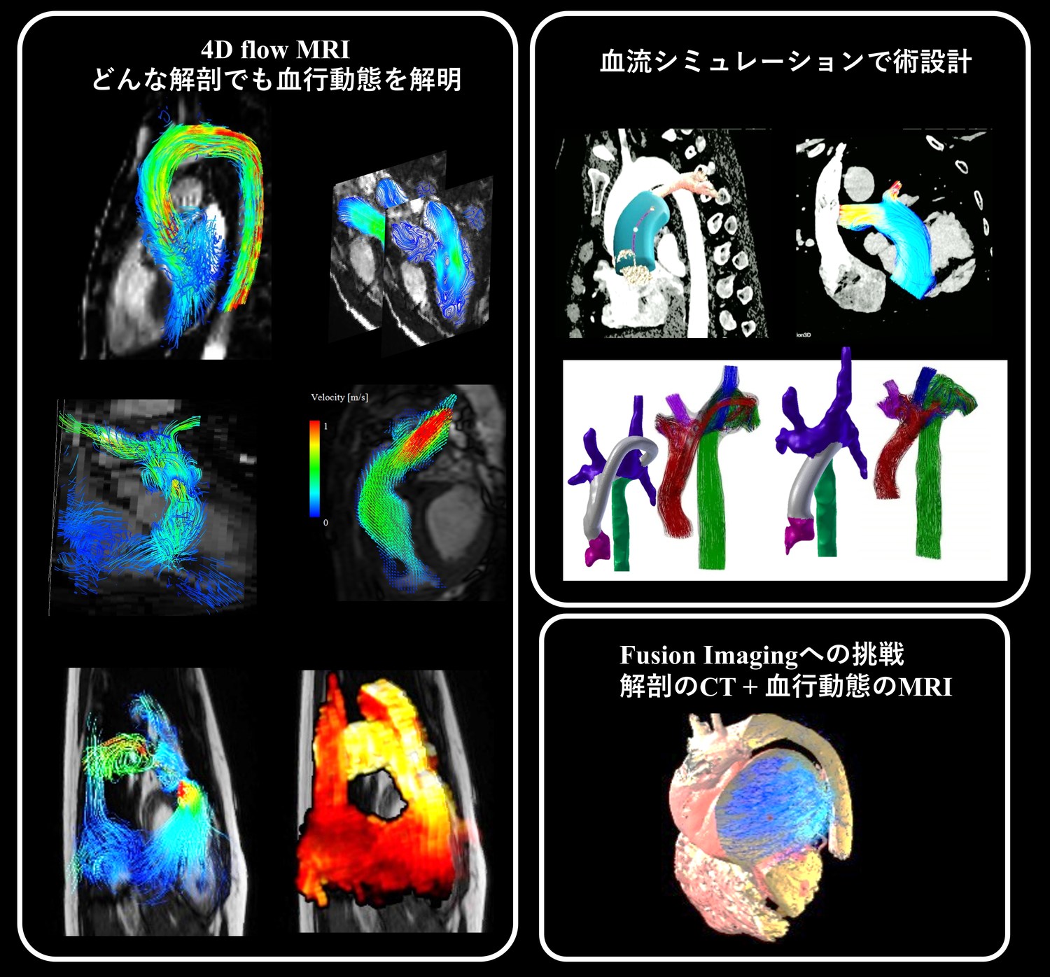 4D flow MRIによる血行動態の可視化と、血流シミュレーションによる手術設計（板谷医師 提供）