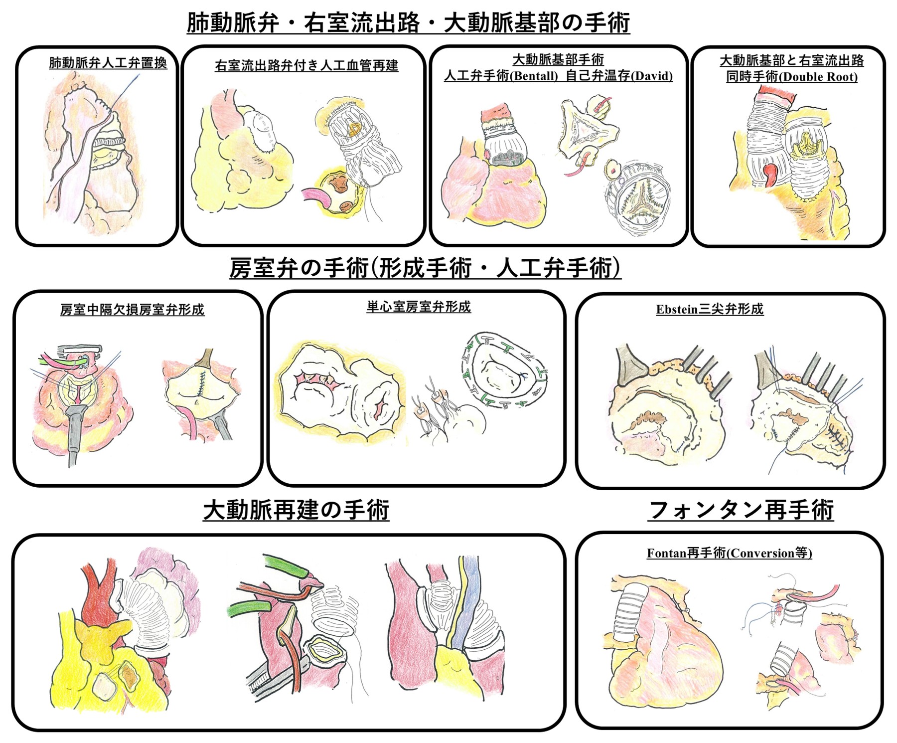 板谷医師がこれまで専門的に手がけてきた成人先天性心疾患の手術（肺動脈弁・右室流出路・大動脈基部の手術、房室弁の手術、大動脈再建の手術、フォンタン再手術）の解説図