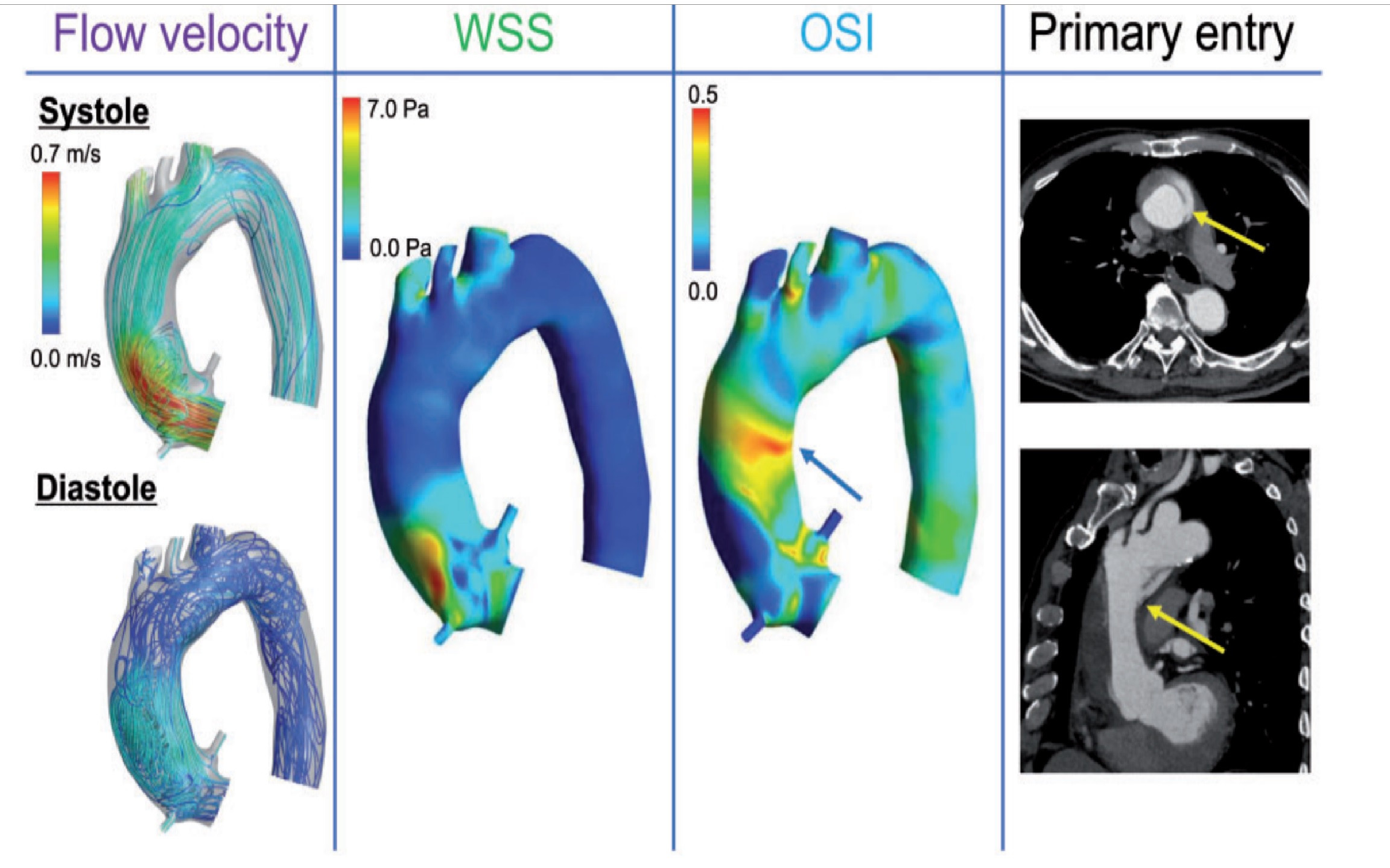 Prediction for future occurrence of type A aortic dissection
